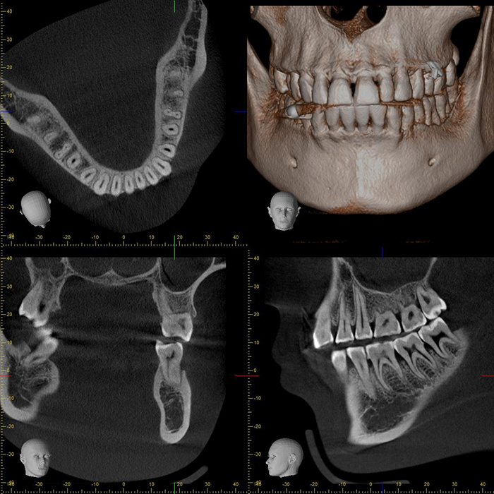 歯科用CT　撮影画像